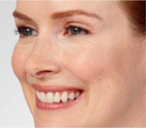 Crow's feet (lateral canthal lines) — after treatment with Dr. Boris Zaks, MD, Beverly Hills