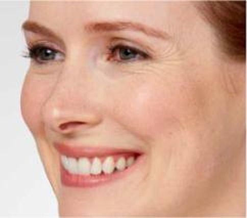 Crow's feet (lateral canthal lines) — before treatment with Dr. Boris Zaks, MD, Beverly Hills