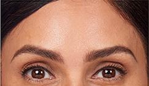 Horizontal forehead lines — after treatment with Dr. Boris Zaks, MD, Beverly Hills