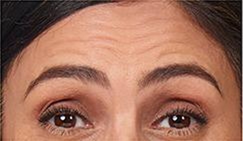 Horizontal forehead lines — before treatment with Dr. Boris Zaks, MD, Beverly Hills