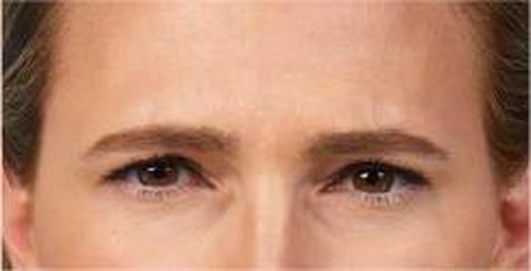 Glabellar (frown) lines at maximum frown — after treatment with Dr. Boris Zaks, MD, Beverly Hills