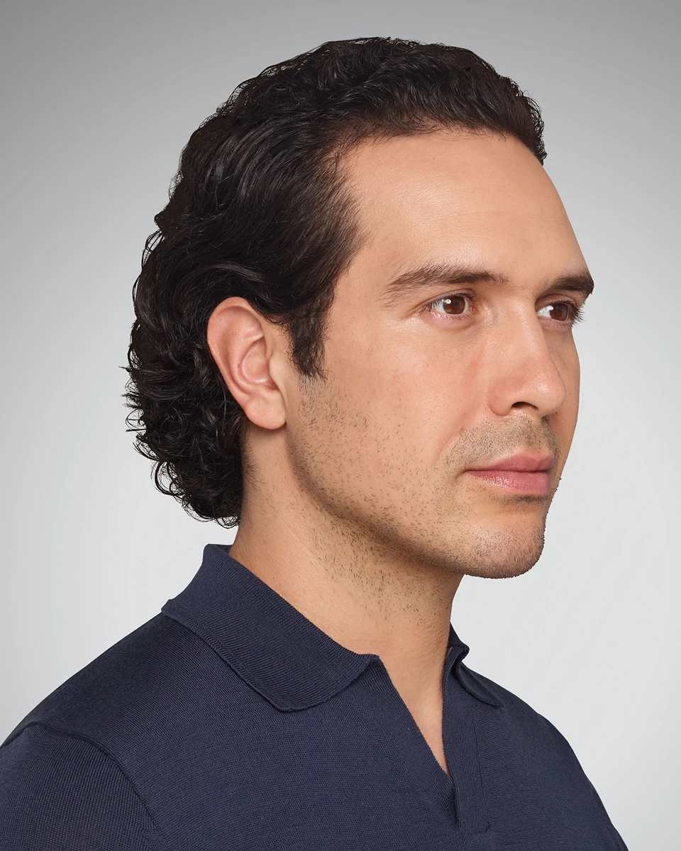 Cheekbone definition, frontal view — after treatment with Dr. Boris Zaks, MD, Beverly Hills