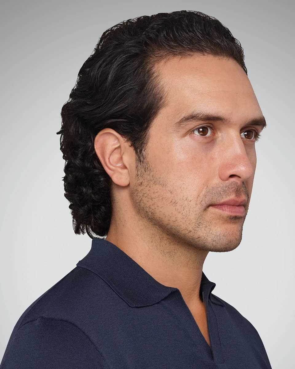 Cheekbone definition, frontal view — before treatment with Dr. Boris Zaks, MD, Beverly Hills
