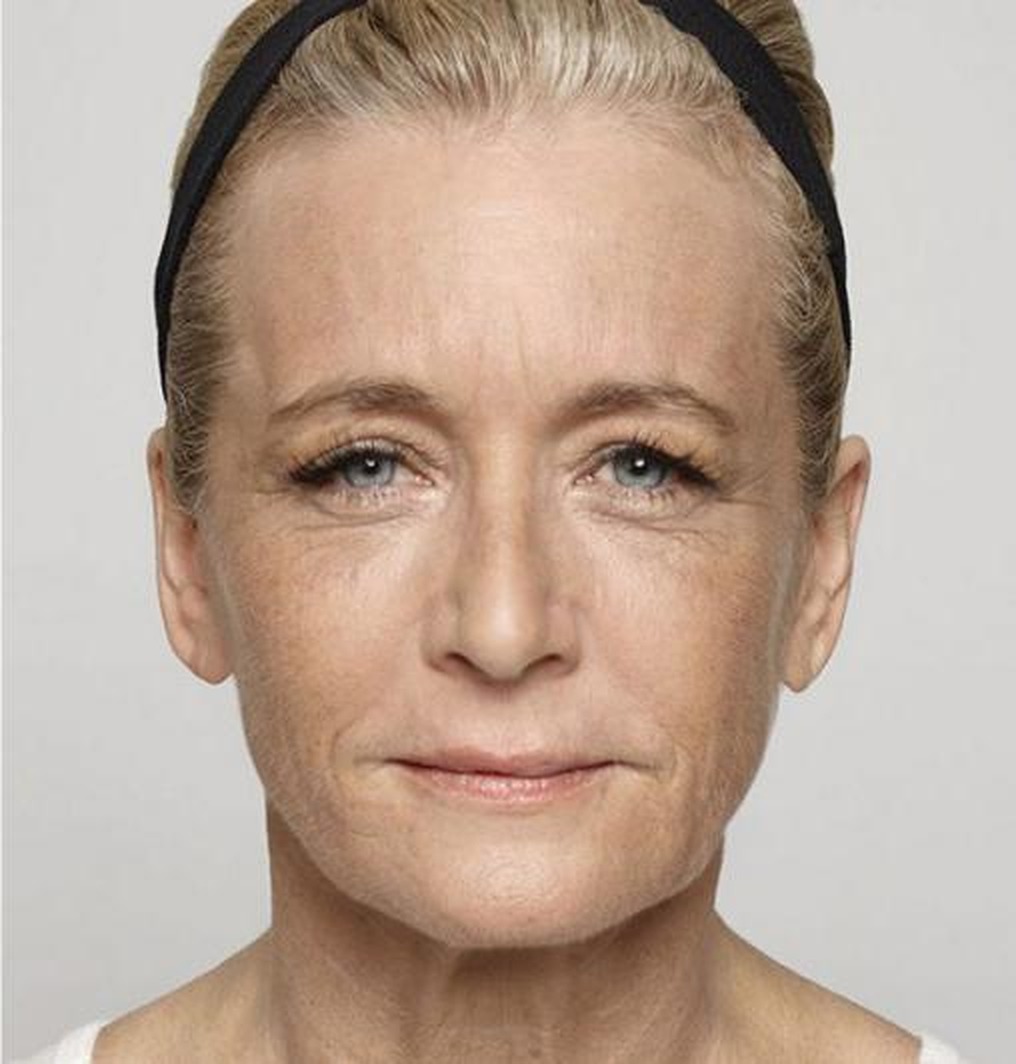 Glabellar (frown) lines, second patient — after treatment with Dr. Boris Zaks, MD, Beverly Hills