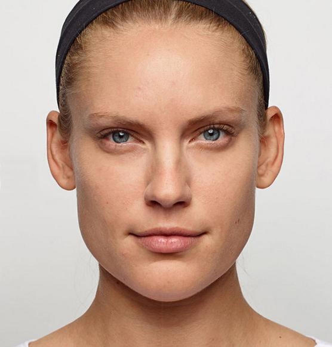 Glabellar (frown) lines at maximum frown — after treatment with Dr. Boris Zaks, MD, Beverly Hills