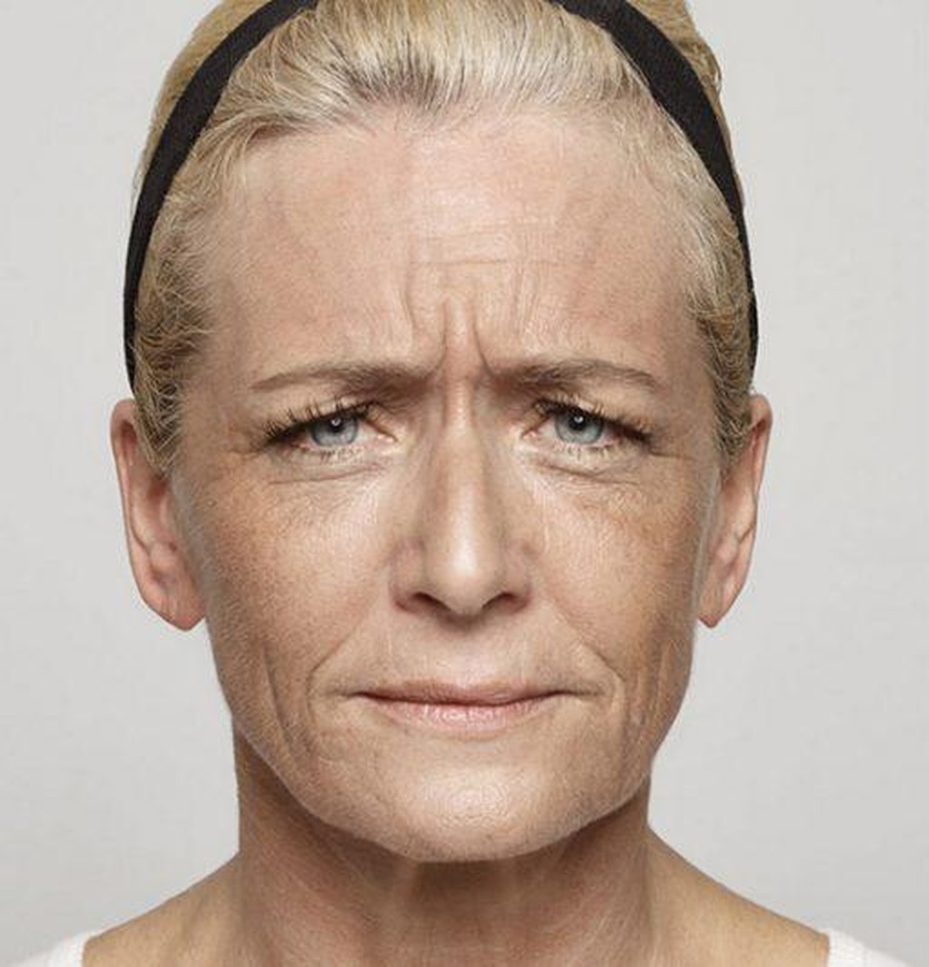 Glabellar (frown) lines, second patient — before treatment with Dr. Boris Zaks, MD, Beverly Hills