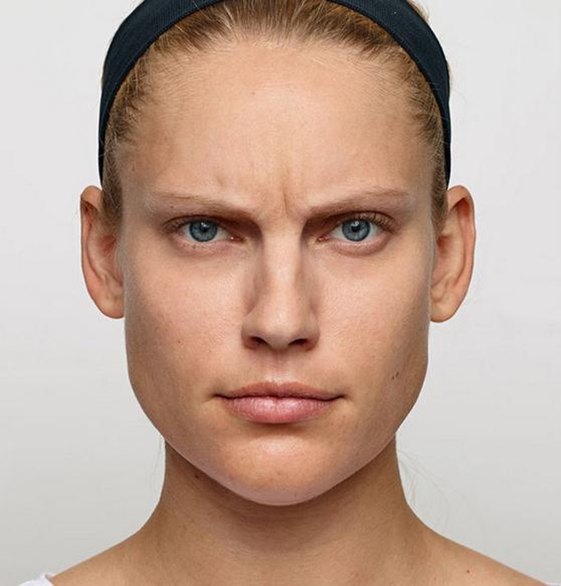 Glabellar (frown) lines at maximum frown — before treatment with Dr. Boris Zaks, MD, Beverly Hills