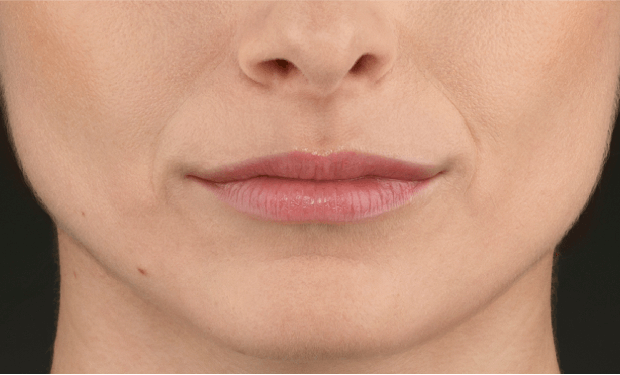 Nasolabial fold correction — after treatment with Dr. Boris Zaks, MD, Beverly Hills