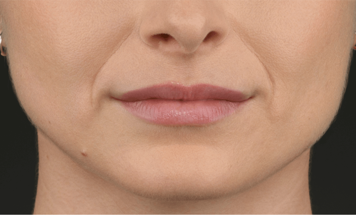 Nasolabial fold correction — before treatment with Dr. Boris Zaks, MD, Beverly Hills