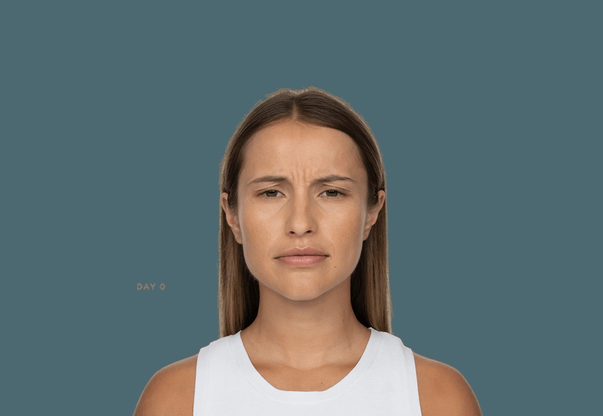 Moderate glabellar lines at maximum frown — baseline vs. day 30 — before treatment with Dr. Boris Zaks, MD, Beverly Hills