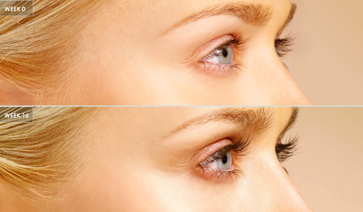 Lash length and fullness, close view — before treatment with Dr. Boris Zaks, MD, Beverly Hills