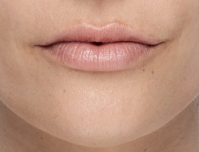 Lip volume and border definition — after treatment with Dr. Boris Zaks, MD, Beverly Hills