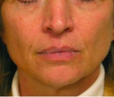 Neck and submental laxity — after treatment with Dr. Boris Zaks, MD, Beverly Hills