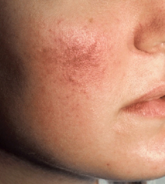 Facial redness and visible vessels treated with the Vbeam® pulsed dye laser — after treatment with Dr. Boris Zaks, MD, Beverly Hills