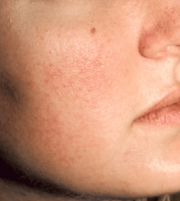 Facial redness and visible vessels treated with the Vbeam® pulsed dye laser — before treatment with Dr. Boris Zaks, MD, Beverly Hills